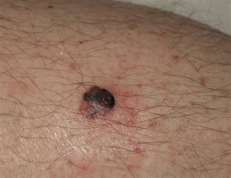 Nodular Melanoma USA Stockists | www.pinnaxis.com