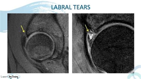 MRI Hip Labrum Tears - Radedasia