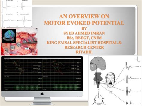 Overview on Motor evoked potential