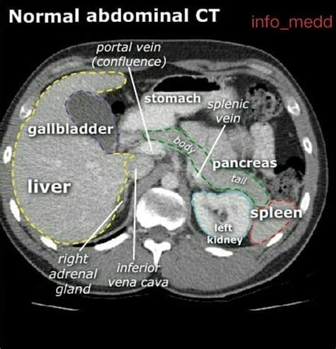 Read More and Download Book immediately Abdominal CT (transverse view) Follow @info_medd # ...