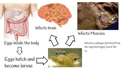 Neurocisticcircosis symptoms and treatment. Why is pork tapeworm so ...