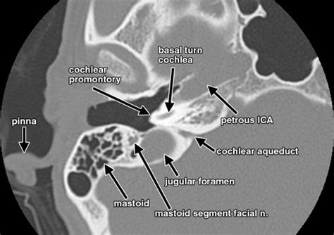 Interactive Web-based Learning Module on CT of the Temporal Bone ...