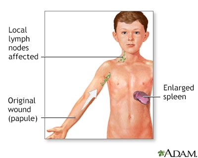 Cat-scratch disease Information | Mount Sinai - New York