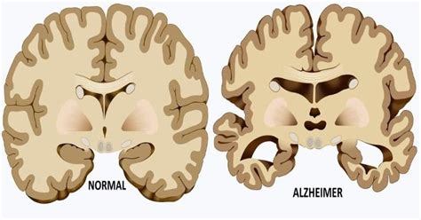 5 Hidden Causes of Alzheimer's Most People Don't Know! - DavidWolfe.com