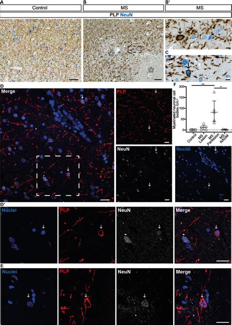 Mistargeted myelin profiles are present in remyelinating lesions in ...