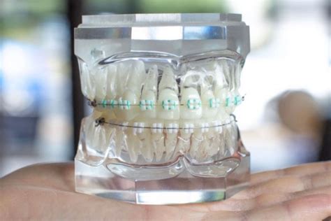 Braces Gold Coast | 35 Years Experience | Gullotta Orthodontics