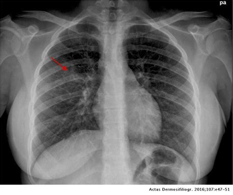 Mycoplasma Pneumonia Rash