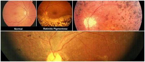 Retinitis Pigmentosa: Common Symptoms, Diagnosis, Causes and Treatment - Hoool Health & Wellness