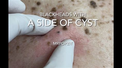 Blackheads with a side of cyst.Blackhead extractions and cyst excision with closure.Cyst ...