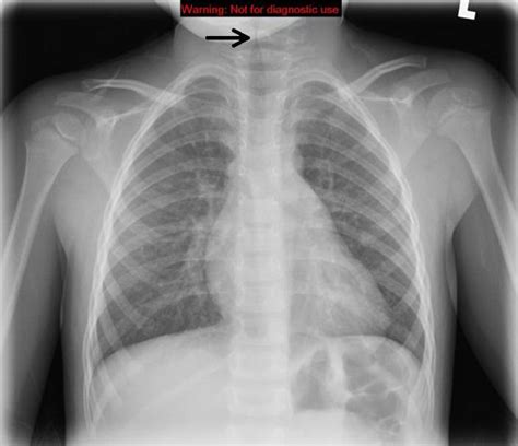 Croup chest x ray - wikidoc