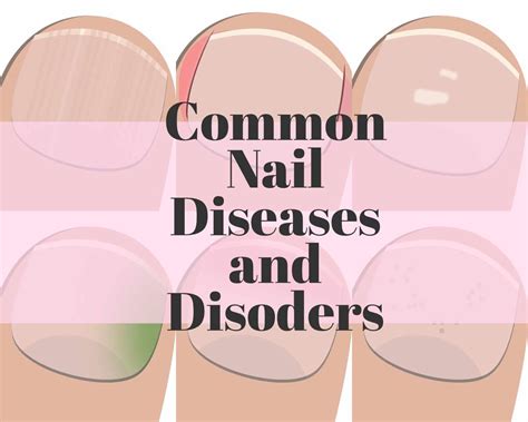 13 Common nail diseases and disorders – The Nail Tech Diaries