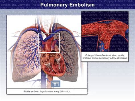 Pulmonary Embolism - Trial Exhibits Inc.