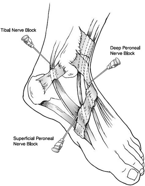 Plantar Nerve Block