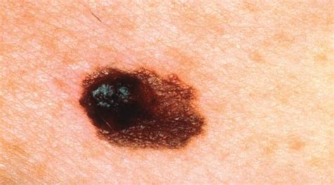 Malignant Melanoma Treatment In SG - Stratum Skin and Surgery