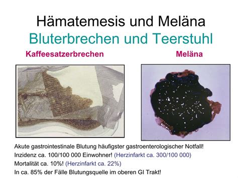 Hämatemesis und Mälena Bluterbrechen und schwarzer Stuhl