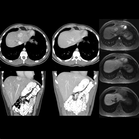 Pediatric Focal Nodular Hyperplasia | Pediatric Radiology Reference Article | Pediatric Imaging ...