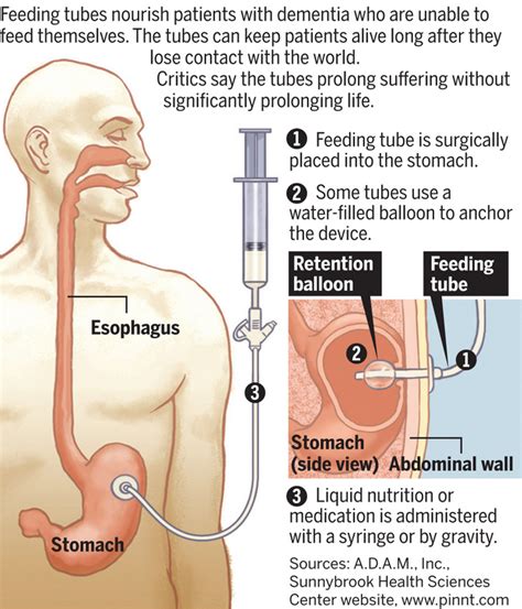 Unfrazzle: End of Life: Is Starvation Better than a Feeding Tube?