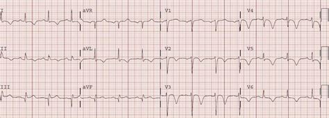 Dr. Smith's ECG Blog: Classic Evolution of Wellens' T-waves over 26 hours