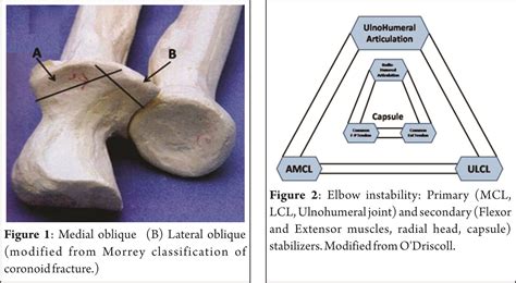 Terrible Triad – Is no More Terrible! – Journal of Clinical Orthopaedics