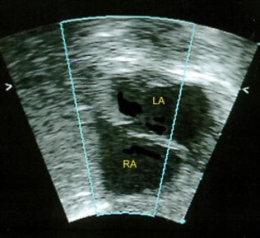 Patent Foramen Ovale: Practice Essentials, Background, Pathophysiology