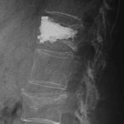 Kyphoplasty treatment performed at L1 level. Sequential intraoperative... | Download Scientific ...