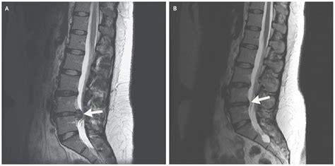 Resolution of Lumbar Disk Herniation without Surgery | NEJM