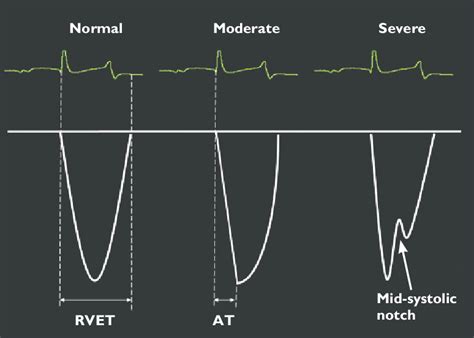 Schematic drawing of the patterns of pulmonary artery flow recorded by... | Download Scientific ...