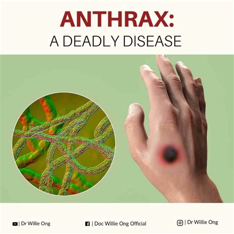 Anthrax: A Deadly Disease - Doc Willie Ong