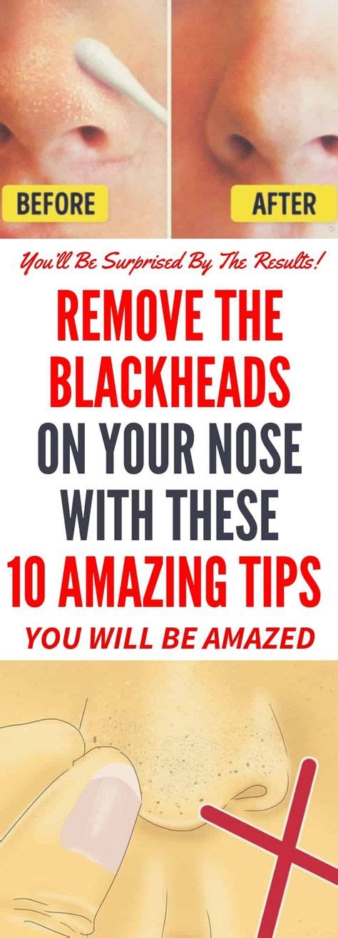 Remove The Blackheads On Your Nose With These 10 Amazing Tips ...