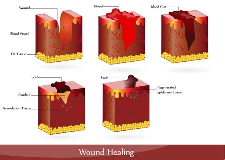 Vector of The process of wound healing. - ID:9233644 - Royalty Free ...