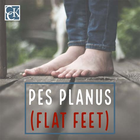 VA Disability Ratings for Pes Planus (Flat Feet) Explained | CCK Law