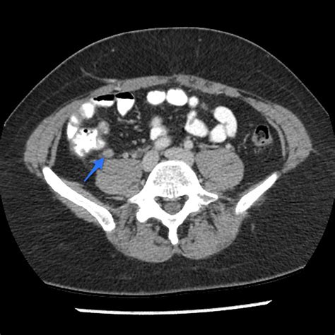 Appendicitis Ct Radiopaedia It is a very common condition in general ...