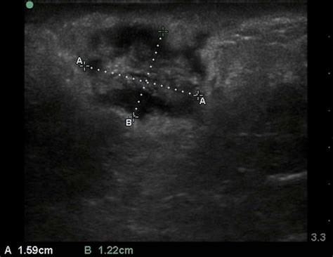 Infecting the Masses: Soft Tissue Infections and Ultrasound EMRA