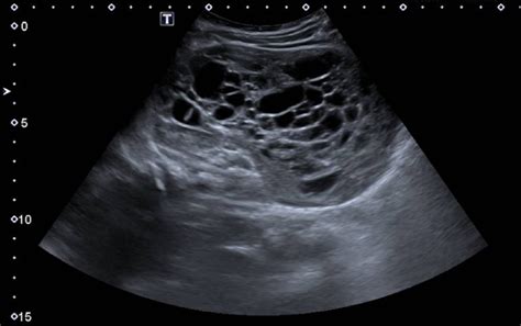 -Ultrasonography showing multilocular cystic mass with variably sized ...