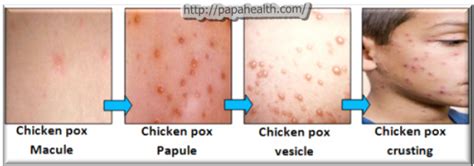 Clinical manifestations and treatment - Chickenpox (varicella)