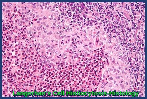 Langerhan's Cell Histiocytosis | Ask Hematologist | Understand Hematology