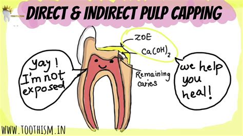 Direct And Indirect Pulp Capping Vital Pulp Therapy Explained In Detail – Otosection