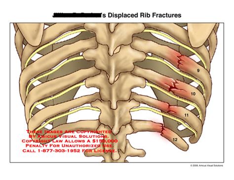 Displaced Rib Fractures