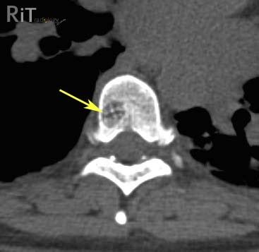 RiT radiology: Spinal Hemangioma