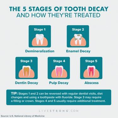 Tooth Decay: Stages, Causes, Treatment and Prevention | livestrong