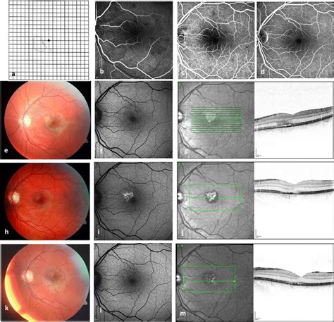 Case 3 with AMN type 3 a Amsler grid chart of the left eye showing... | Download Scientific Diagram