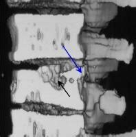 Lumbar Spine: Endplate Spurring Lumbar Spine