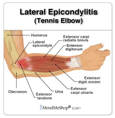 Anatomy of the elbow - the tendons and soft tissue that are affected by tennis elbow (lateral ...