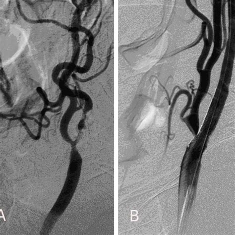 (Case 196). Severe left ICA stensosis with severe calcification. A ...