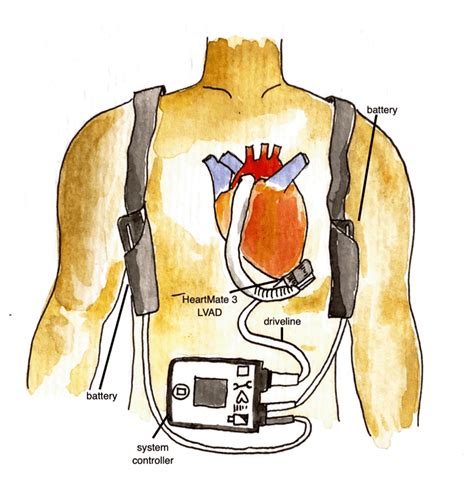 EMCrit 334 - CV-EMCrit - Concise HeartMate 3 LVAD Overview