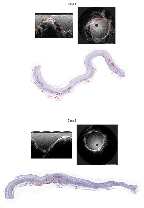 Computational imaging by CEUS and histological evidence of vasa vasorum ...