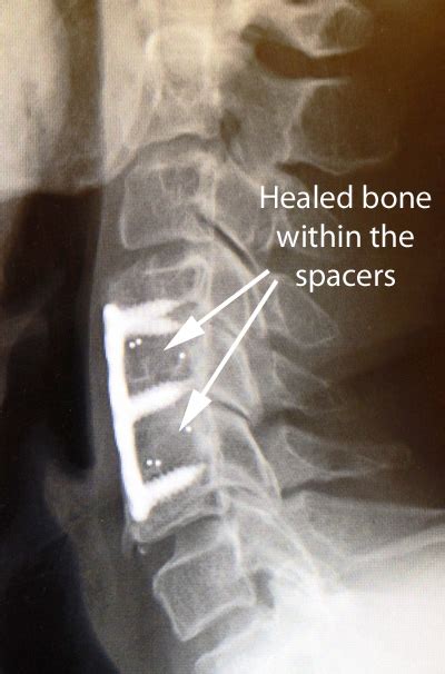 Anterior Cervical Discectomy and Fusion (ACDF) - Drwolgin