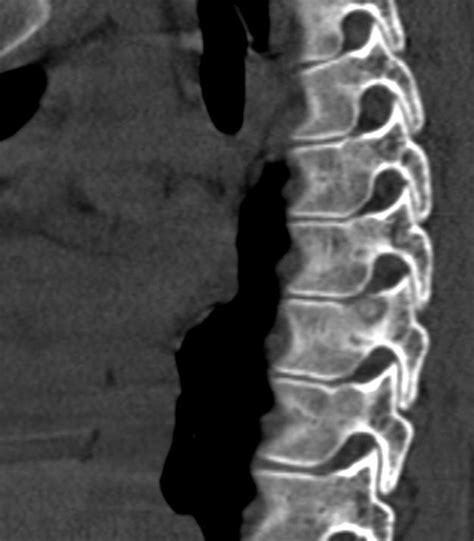 Osteoid Osteoma Spine Mri