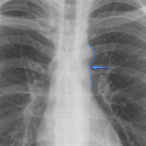 Aortic coarctation | Radiology Case | Radiopaedia.org Coarctation Of The Aorta, Medical Imaging ...