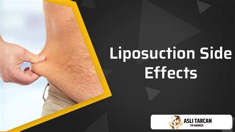 Liposuction Side Effects